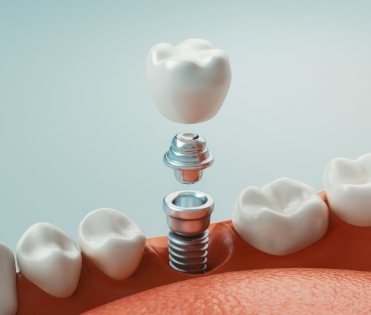 Illustrated dental implant with abutment and crown in lower jaw