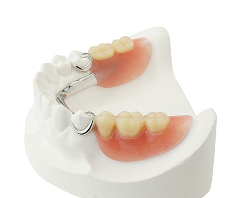 partial denture sitting on model of teeth 