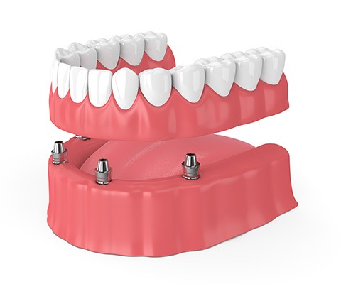 dental implant denture 